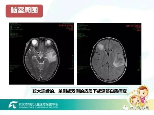 【PPT】小儿NMOSD及其相关疾病MRI诊断思路
