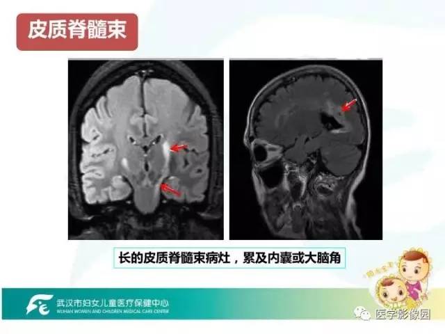 【PPT】小儿NMOSD及其相关疾病MRI诊断思路