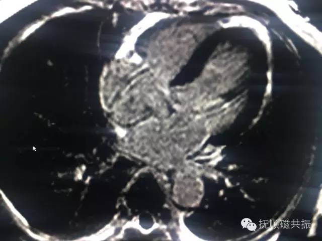 【病例】心肌致密化不全1例MR影像诊断 【病例】心肌致密化不全1例MR影像诊断
