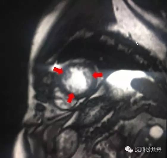 【病例】心肌致密化不全1例MR影像诊断 【病例】心肌致密化不全1例MR影像诊断