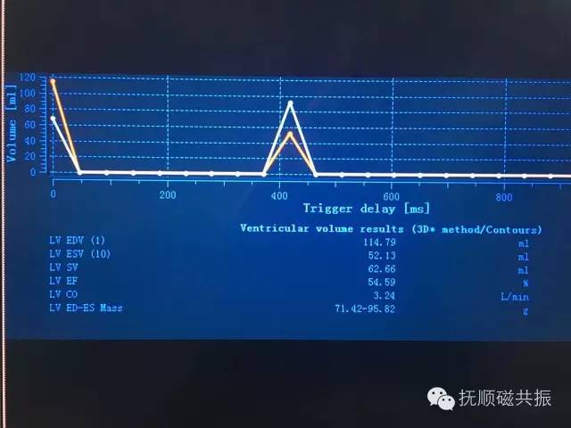 【病例】心肌致密化不全1例MR影像诊断 【病例】心肌致密化不全1例MR影像诊断