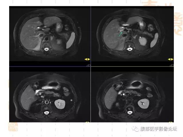 【病例】残留胆囊颈管癌1例CT及MR影像表现 【病例】残留胆囊颈管癌1例CT及MR影像表现