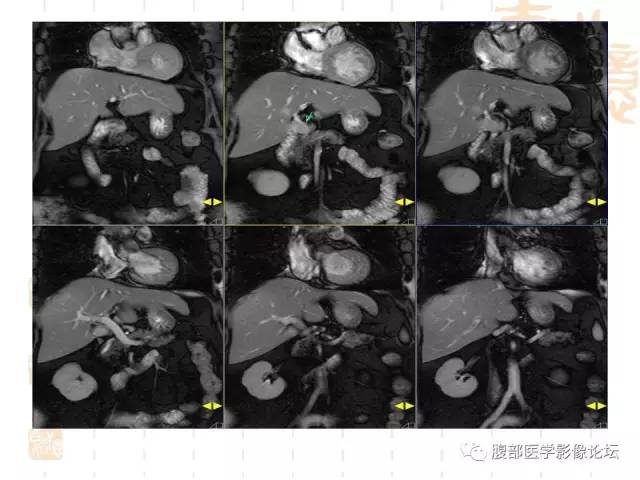 【病例】残留胆囊颈管癌1例CT及MR影像表现 【病例】残留胆囊颈管癌1例CT及MR影像表现