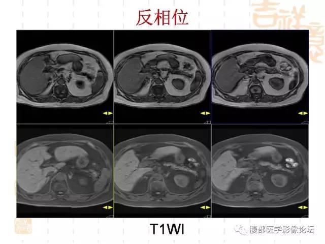 【病例】残留胆囊颈管癌1例CT及MR影像表现 【病例】残留胆囊颈管癌1例CT及MR影像表现