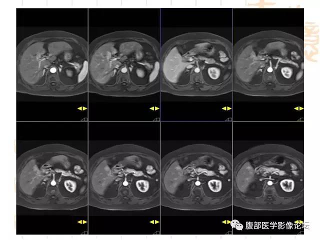 【病例】残留胆囊颈管癌1例CT及MR影像表现 【病例】残留胆囊颈管癌1例CT及MR影像表现