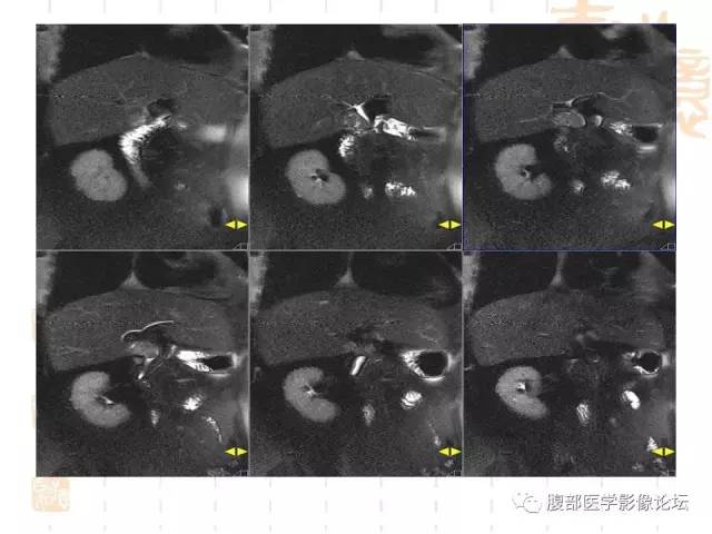 【病例】残留胆囊颈管癌1例CT及MR影像表现 【病例】残留胆囊颈管癌1例CT及MR影像表现