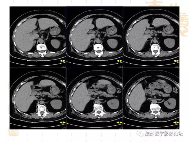 【病例】残留胆囊颈管癌1例CT及MR影像表现 【病例】残留胆囊颈管癌1例CT及MR影像表现