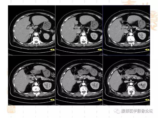 【病例】残留胆囊颈管癌1例CT及MR影像表现 【病例】残留胆囊颈管癌1例CT及MR影像表现