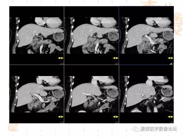 【病例】残留胆囊颈管癌1例CT及MR影像表现 【病例】残留胆囊颈管癌1例CT及MR影像表现