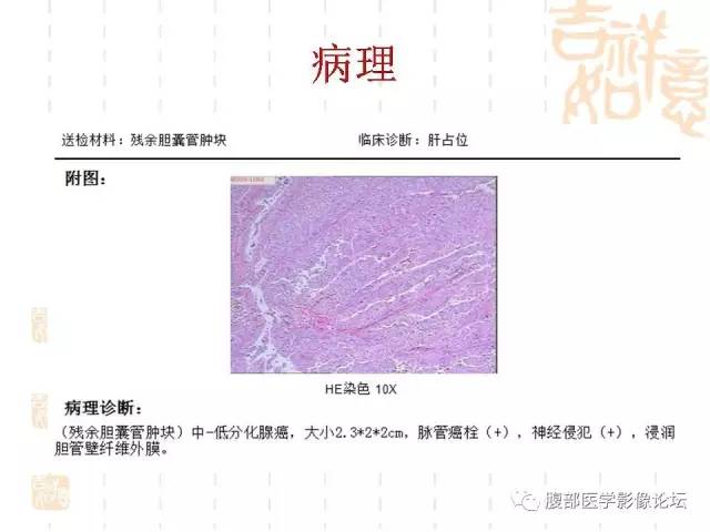 【病例】残留胆囊颈管癌1例CT及MR影像表现 【病例】残留胆囊颈管癌1例CT及MR影像表现