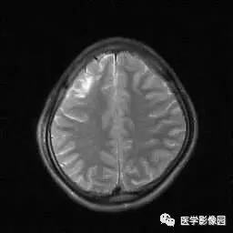 【病例】病毒性脑炎