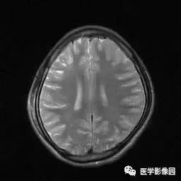 【病例】病毒性脑炎