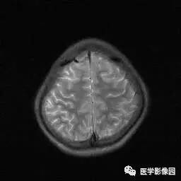 【病例】病毒性脑炎