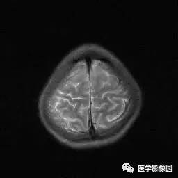 【病例】病毒性脑炎