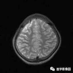 【病例】病毒性脑炎