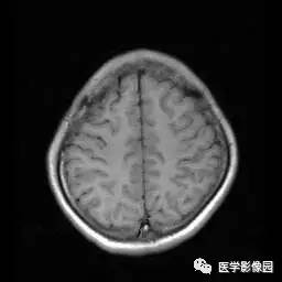 【病例】病毒性脑炎