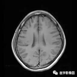【病例】病毒性脑炎