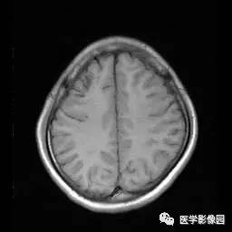 【病例】病毒性脑炎