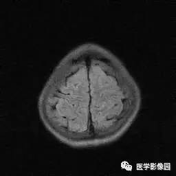 【病例】病毒性脑炎