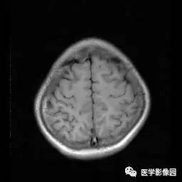 【病例】病毒性脑炎