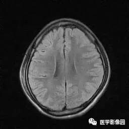 【病例】病毒性脑炎