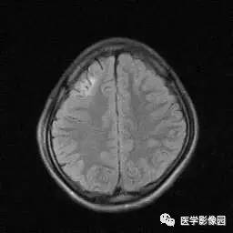 【病例】病毒性脑炎