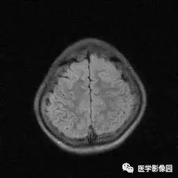 【病例】病毒性脑炎