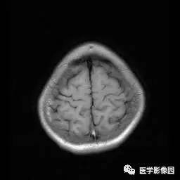 【病例】病毒性脑炎