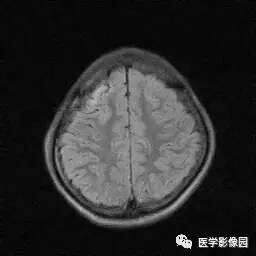 【病例】病毒性脑炎