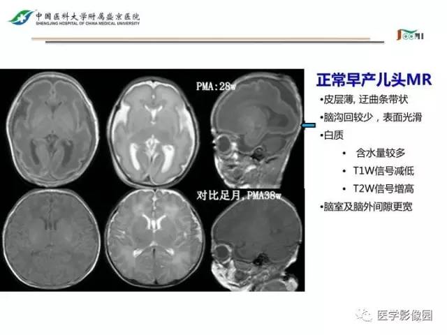 【PPT】常见新生儿脑损伤的MRI检查序列的选择与诊断要点