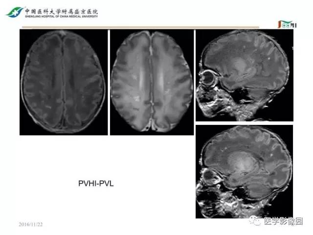 【PPT】常见新生儿脑损伤的MRI检查序列的选择与诊断要点