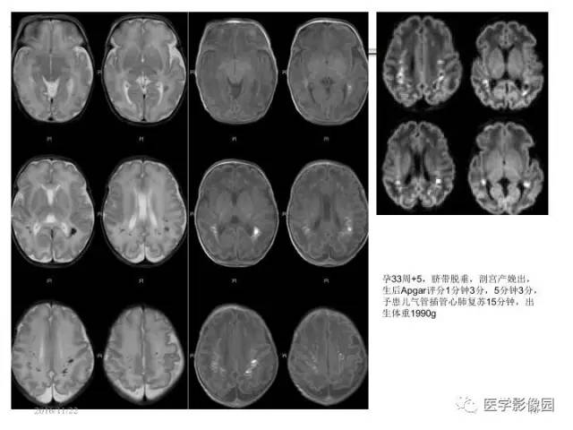 【PPT】常见新生儿脑损伤的MRI检查序列的选择与诊断要点