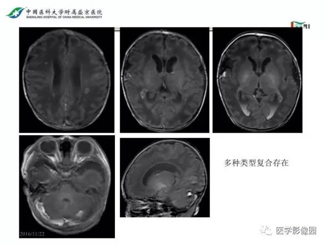 【PPT】常见新生儿脑损伤的MRI检查序列的选择与诊断要点