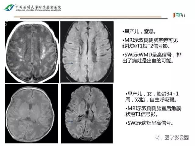 【PPT】常见新生儿脑损伤的MRI检查序列的选择与诊断要点