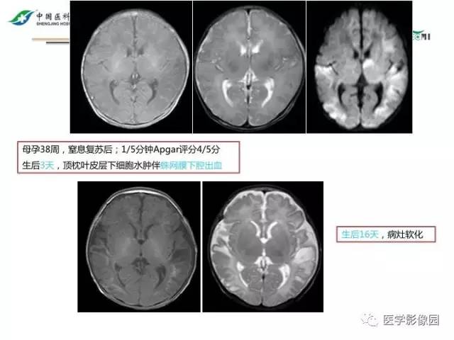 【PPT】常见新生儿脑损伤的MRI检查序列的选择与诊断要点