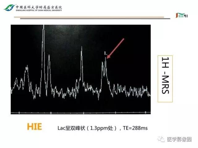 【PPT】常见新生儿脑损伤的MRI检查序列的选择与诊断要点