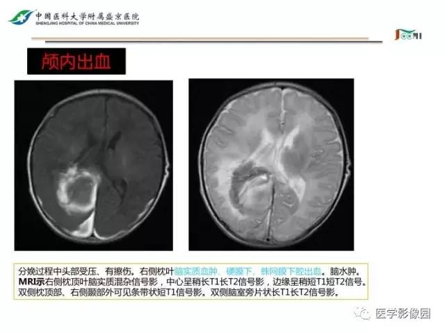 【PPT】常见新生儿脑损伤的MRI检查序列的选择与诊断要点