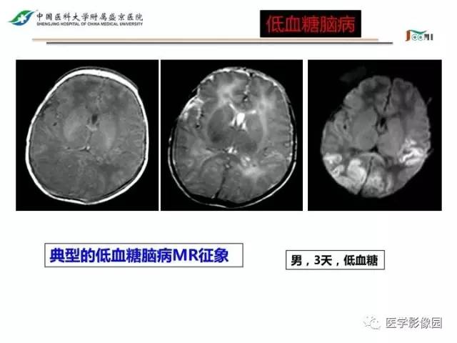 【PPT】常见新生儿脑损伤的MRI检查序列的选择与诊断要点