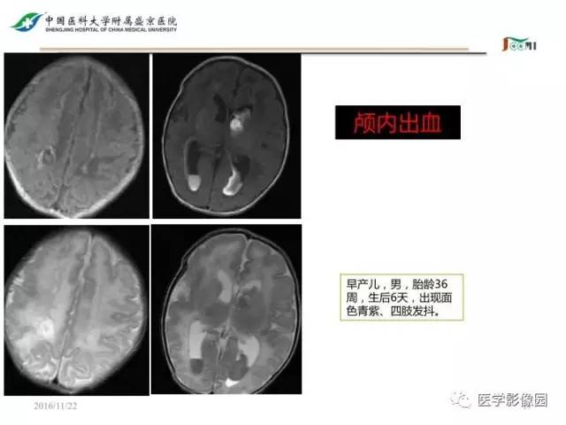 【PPT】常见新生儿脑损伤的MRI检查序列的选择与诊断要点