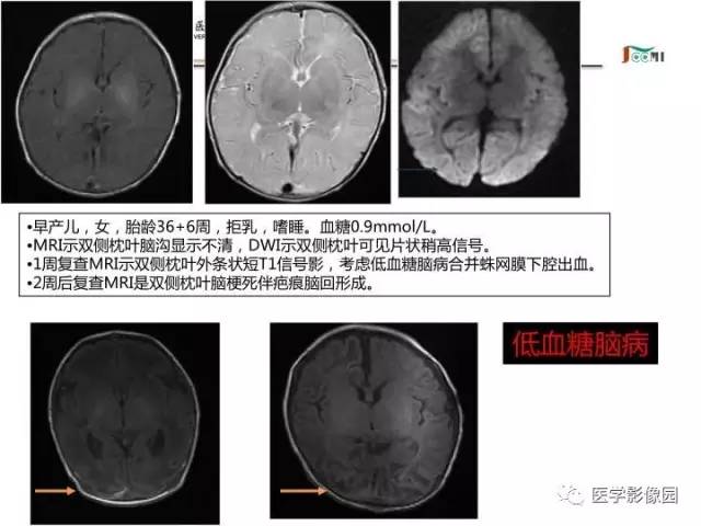 【PPT】常见新生儿脑损伤的MRI检查序列的选择与诊断要点