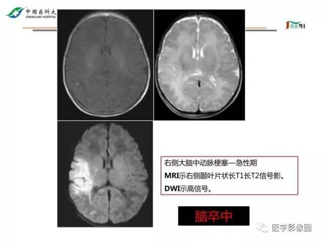 【PPT】常见新生儿脑损伤的MRI检查序列的选择与诊断要点
