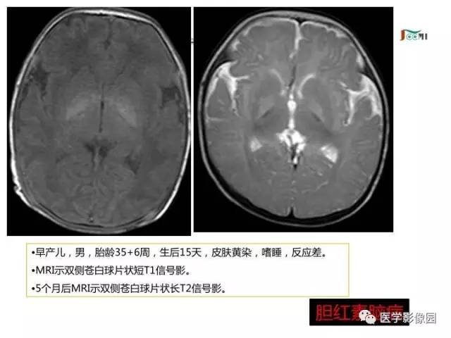 【PPT】常见新生儿脑损伤的MRI检查序列的选择与诊断要点