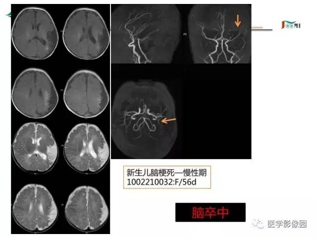 【PPT】常见新生儿脑损伤的MRI检查序列的选择与诊断要点