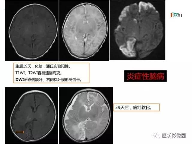【PPT】常见新生儿脑损伤的MRI检查序列的选择与诊断要点