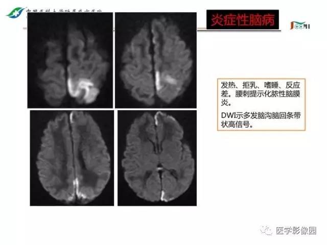 【PPT】常见新生儿脑损伤的MRI检查序列的选择与诊断要点