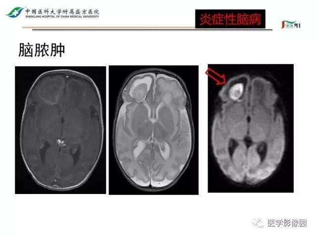 【PPT】常见新生儿脑损伤的MRI检查序列的选择与诊断要点