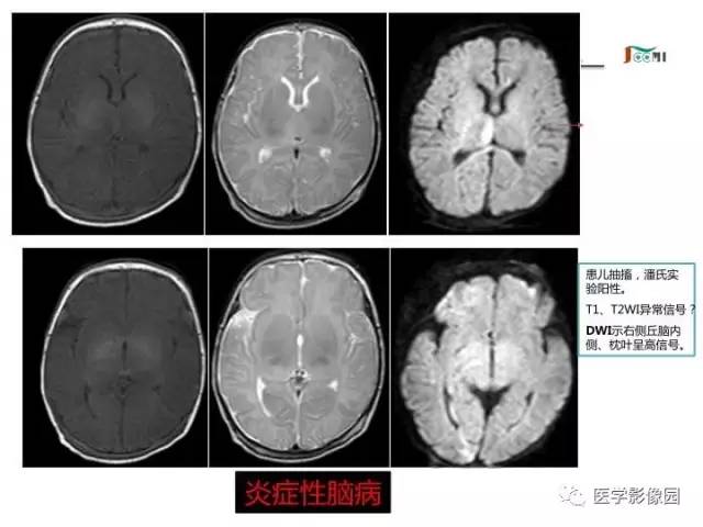 【PPT】常见新生儿脑损伤的MRI检查序列的选择与诊断要点