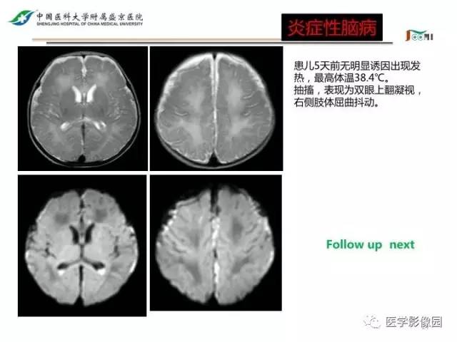 【PPT】常见新生儿脑损伤的MRI检查序列的选择与诊断要点