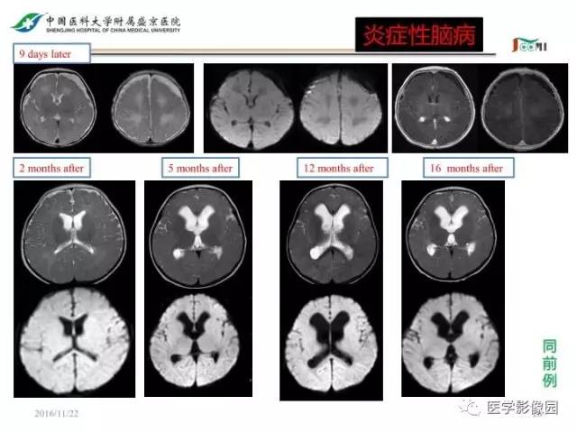【PPT】常见新生儿脑损伤的MRI检查序列的选择与诊断要点