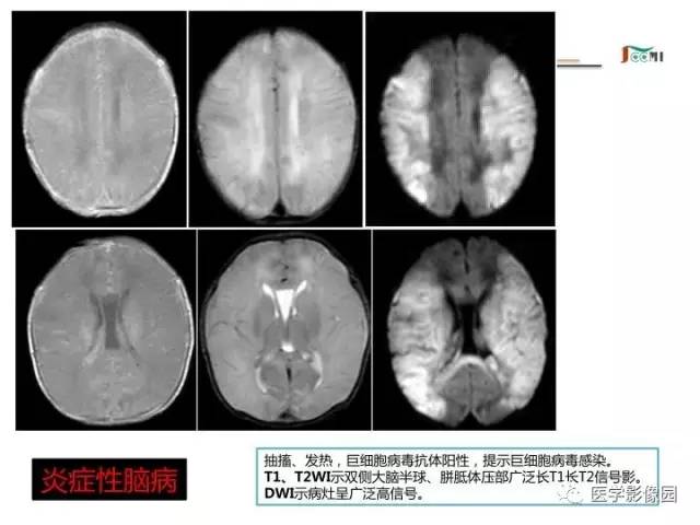 【PPT】常见新生儿脑损伤的MRI检查序列的选择与诊断要点